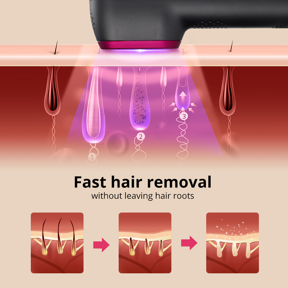 laser hair removal (4)